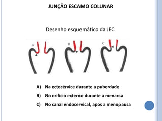 Desenho esquemático da JEC
A) Na ectocérvice durante a puberdade
B) No orifício externo durante a menarca
C) No canal endocervical, após a menopausa
JUNÇÃO ESCAMO COLUNAR
 