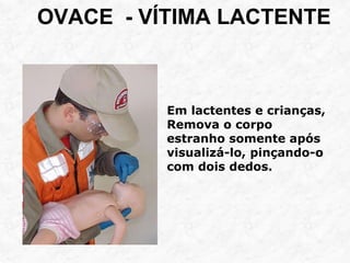 OVACE - VÍTIMA LACTENTE
Em lactentes e crianças,
Remova o corpo
estranho somente após
visualizá-lo, pinçando-o
com dois dedos.
 