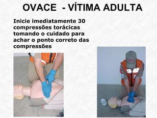 OVACE - VÍTIMA ADULTA
Inicie imediatamente 30
compressões torácicas
tomando o cuidado para
achar o ponto correto das
compressões
 