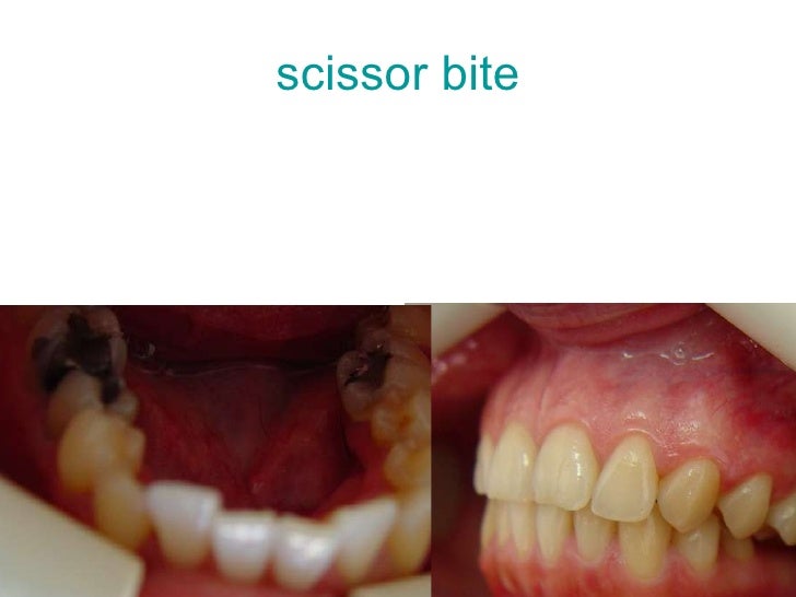classification of malocclusion