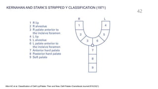 42
Allori AC et al. Classification of Cleft Lip/Palate: Then and Now. Cleft Palate–Craniofacial Journal 2016;53(1)
KERNAHAN AND STARK’S STRIPPED Y CLASSIFICATION (1971)
 
