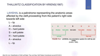 46
Allori AC et al. Classification of Cleft Lip/Palate: Then and Now. Cleft Palate–Craniofacial Journal 2016;53(1)
LAHSHAL is a palindrome representing the anatomic areas
affected by the cleft,proceeding from the patient’s right side
towards left side
L – lip
A – alveolus
H – hard palate
S – soft palate
H – hard palate
A – alveolus
L – lip
THALLWITZ CLASSIFICATION BY KRIENS(1987)
 