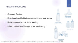  Oronasal fistulas
 Draining of oral fluids in nasal cavity and vice versa
 Bottle, cup and spoon, tube feeding
 Infant held at 30-450 angle to aid swallowing
FEEDING PROBLEMS
56
Lewis CW et al., The Primary Care Pediatrician and the Care of Children With Cleft Lip and/or Cleft Palate AAP Volume 139, number 5, May 2017
 