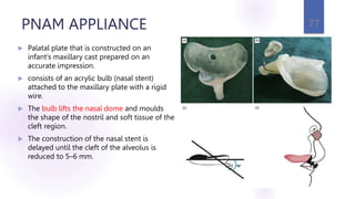 PNAM APPLIANCE
 Palatal plate that is constructed on an
infant’s maxillary cast prepared on an
accurate impression.
 consists of an acrylic bulb (nasal stent)
attached to the maxillary plate with a rigid
wire.
 The bulb lifts the nasal dome and moulds
the shape of the nostril and soft tissue of the
cleft region.
 The construction of the nasal stent is
delayed until the cleft of the alveolus is
reduced to 5–6 mm.
77
 