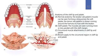 92
Anatomy of the cleft lip and palate.
(A) Normal anatomy: the levator veli palatini muscle
can be seen forming a sling across the soft
palate; the tensor veli palatini is shown coming
around the hamulus to fuse with the levator.
(B) Cleft palate: The muscles are seen running more
or less parallel with the cleft margin.
(C) Circumoral muscle attachments in cleft lip and
palate
(D) Blood supply to the circumoral region in cleft lip
and palate
 