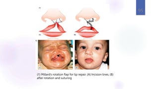 95
(1) Millard’s rotation flap for lip repair. (A) Incision lines, (B)
after rotation and suturing
 