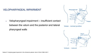  Velopharyngeal impairment – insufficient contact
between the velum and the posterior and lateral
pharyngeal walls
VELOPHARYNGEAL IMPAIRMENT
139
Dalston R. Velopharyngeal Impairment in the orthodontic patients. Semin Orthod 1996;2:220-7.
 