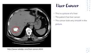 Liver Cancer
• This is a picture of a liver.
• The patient has liver cancer
• The cancer look very smooth in the
picture.
 
