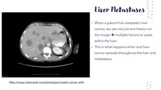Liver Metastases
• When a patient has metastatic liver
cancer, we see not just one lession on
the image ➔ multiple lesions or spots
within the liver.
• This is what happens when one liver
cancer spreads throughout the liver and
metastases.
 