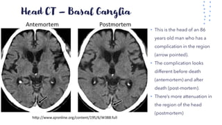 Head CT – Basal Ganglia
• This is the head of an 86
years old man who has a
complication in the region
(arrow pointed).
• The complication looks
different before death
(antemortem) and after
death (post-mortem).
• There’s more attenuation in
the region of the head
(postmortem)
 