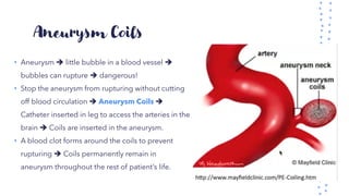 Aneurysm Coils
• Aneurysm ➔ little bubble in a blood vessel ➔
bubbles can rupture ➔ dangerous!
• Stop the aneurysm from rupturing without cutting
off blood circulation ➔ Aneurysm Coils ➔
Catheter inserted in leg to access the arteries in the
brain ➔ Coils are inserted in the aneurysm.
• A blood clot forms around the coils to prevent
rupturing ➔ Coils permanently remain in
aneurysm throughout the rest of patient’s life.
 