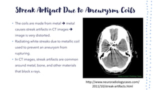 Streak Artifact Due to Aneurysm Coils
• The coils are made from metal ➔ metal
causes streak artifacts in CT images ➔
image is very distorted.
• Radiating white streaks due to metallic coil
used to prevent an aneurysm from
rupturing.
• In CT images, streak artifacts are common
around metal, bone, and other materials
that block x-rays.
 