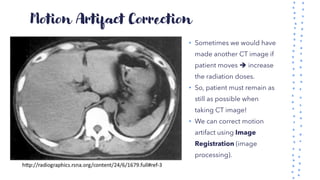 Motion Artifact Correction
• Sometimes we would have
made another CT image if
patient moves ➔ increase
the radiation doses.
• So, patient must remain as
still as possible when
taking CT image!
• We can correct motion
artifact using Image
Registration (image
processing).
 