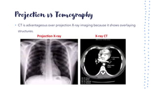 Projection vs Tomography
• CT is advantageous over projection X-ray imaging because it shows overlaying
structures.
 