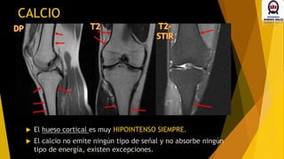 CALCIO
 El hueso cortical es muy HIPOINTENSO SIEMPRE.
 El calcio no emite ningún tipo de señal y no absorbe ningún
tipo de energía, existen excepciones.
 