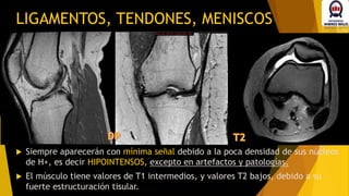 LIGAMENTOS, TENDONES, MENISCOS
 Siempre aparecerán con mínima señal debido a la poca densidad de sus núcleos
de H+, es decir HIPOINTENSOS, excepto en artefactos y patologías.
 El músculo tiene valores de T1 intermedios, y valores T2 bajos, debido a su
fuerte estructuración tisular.
 