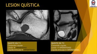 LESION QUÍSTICA
QUISTE EN T1
Contenido Líquido
Lesión  HIPOINTENSO
Líquido Articular HIPOINTENSO
QUISTE EN T2
Contenido Líquido
Lesión  HIPERINTENSO
Líquido Articular HIPERINTENSO
 