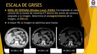  NIVEL DE VENTANA (Window Level WW): Corresponde al valor
central de la escala de números CT dentro del ancho de ventana
asignado a la imagen. Determina el ennegrecimiento de la
imagen, el BRILLO.
 A mayor WL la imagen se optimiza para hueso.
ESCALA DE GRISES
 
