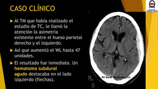  Al TM que había realizado el
estudio de TC, le llamó la
atención la asimetría
existente entre el hueso parietal
derecho y el izquierdo.
 Así que aumentó el WL hasta 47
unidades.
 El resultado fue inmediato. Un
hematoma subdural
agudo destacaba en el lado
izquierdo (flechas).
CASO CLÍNICO
 