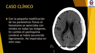  Con la pequeña modificación
de los parámetros físicos el
hematoma se apreciaba con
nitidez en todas las imágenes.
En cambio el parénquima
cerebral se había oscurecido
ligeramente. No importaba en
este caso.
CASO CLÍNICO
 