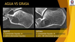 AGUA VS GRASA
QUISTE
• Contenido líquido  HIPODENSO
• UH=0 (Densidad líquida)
LIPOMA
• Contenido líquido  HIPODENSO
• UH= -80 (Densidad grasa)
 