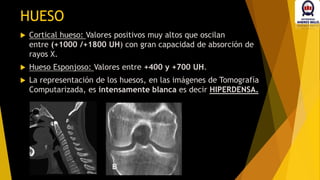  Cortical hueso: Valores positivos muy altos que oscilan
entre (+1000 /+1800 UH) con gran capacidad de absorción de
rayos X.
 Hueso Esponjoso: Valores entre +400 y +700 UH.
 La representación de los huesos, en las imágenes de Tomografía
Computarizada, es intensamente blanca es decir HIPERDENSA.
HUESO
 