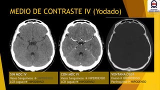 MEDIO DE CONTRASTE IV (Yodado)
SIN MDC IV
Vasos Sanguíneos  HIPODENSO
LCR (agua) HIPODENSO
CON MDC IV
Vasos Sanguíneos  HIPERDENSO
LCR (agua) HIPODENSO
VENTANA ÓSEA
Hueso HIPERDENSO
Parénquima HIPODENSO
 
