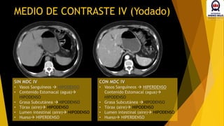 MEDIO DE CONTRASTE IV (Yodado)
SIN MDC IV
• Vasos Sanguíneos  HIPODENSO
• Contenido Estomacal (agua)
HIPODENSO
• Grasa Subcutánea HIPODENSO
• Tórax (aire) HIPODENSO
• Lumen intestinal (aire) HIPODENSO
• Hueso HIPERDENSO
CON MDC IV
• Vasos Sanguíneos  HIPERDENSO
Contenido Estomacal (agua)
HIPODENSO
• Grasa Subcutánea HIPODENSO
• Tórax (aire) HIPODENSO
• Lumen intestinal (aire) HIPODENSO
• Hueso HIPERDENSO
 