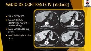 MEDIO DE CONTRASTE IV (Yodado)
 SIN CONTRASTE
 FASE ARTERIAL
(temprana 120 UH -
tardía 30 seg)
 FASE VENOSA (60 seg
prom.)
 FASE TARDIA (90 a 120
seg)
 