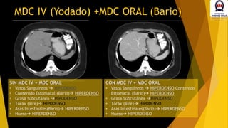 SIN MDC IV + MDC ORAL
• Vasos Sanguíneos  HIPODENSO
• Contenido Estomacal (Bario) HIPERDENSO
• Grasa Subcutánea HIPODENSO
• Tórax (aire) HIPODENSO
• Asas Intestinales(Bario) HIPERDENSO
• Hueso HIPERDENSO
MDC IV (Yodado) +MDC ORAL (Bario)
CON MDC IV + MDC ORAL
• Vasos Sanguíneos  HIPERDENSO Contenido
Estomacal (Bario) HIPERDENSO
• Grasa Subcutánea HIPODENSO
• Tórax (aire) HIPODENSO
• Asas Intestinales(Bario) HIPERDENSO
• Hueso HIPERDENSO
 