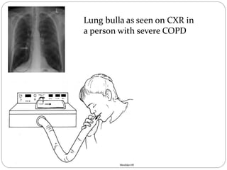 Lung bulla as seen on CXR in
a person with severe COPD
 
