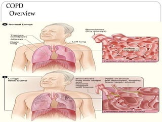 COPD
Overview
 