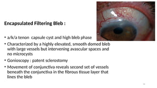 Complication of Glaucoma Surgery (Trabeculectomy) .pptx