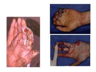 Les brûlures électrothermiques
 