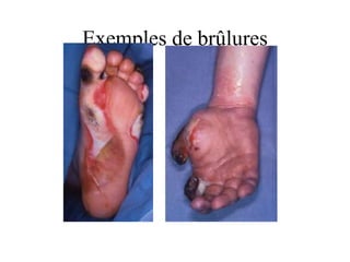 Exemples de brûlures
 
