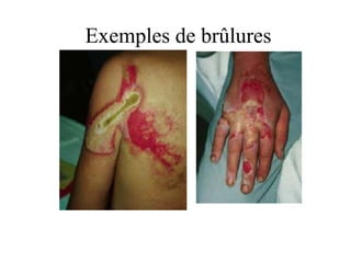 Exemples de brûlures
 