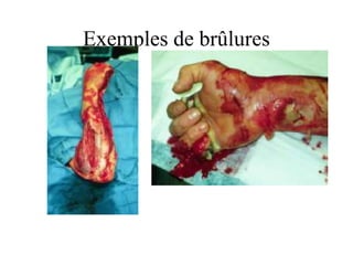 Exemples de brûlures
 