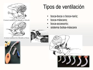 Tipos de ventilación
• boca-boca o boca-nariz;
• boca-máscara;
• boca-accesorio;
• sistema bolsa-máscara
 