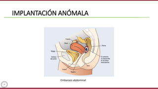 IMPLANTACIÓN ANÓMALA
Embarazo abdominal
 