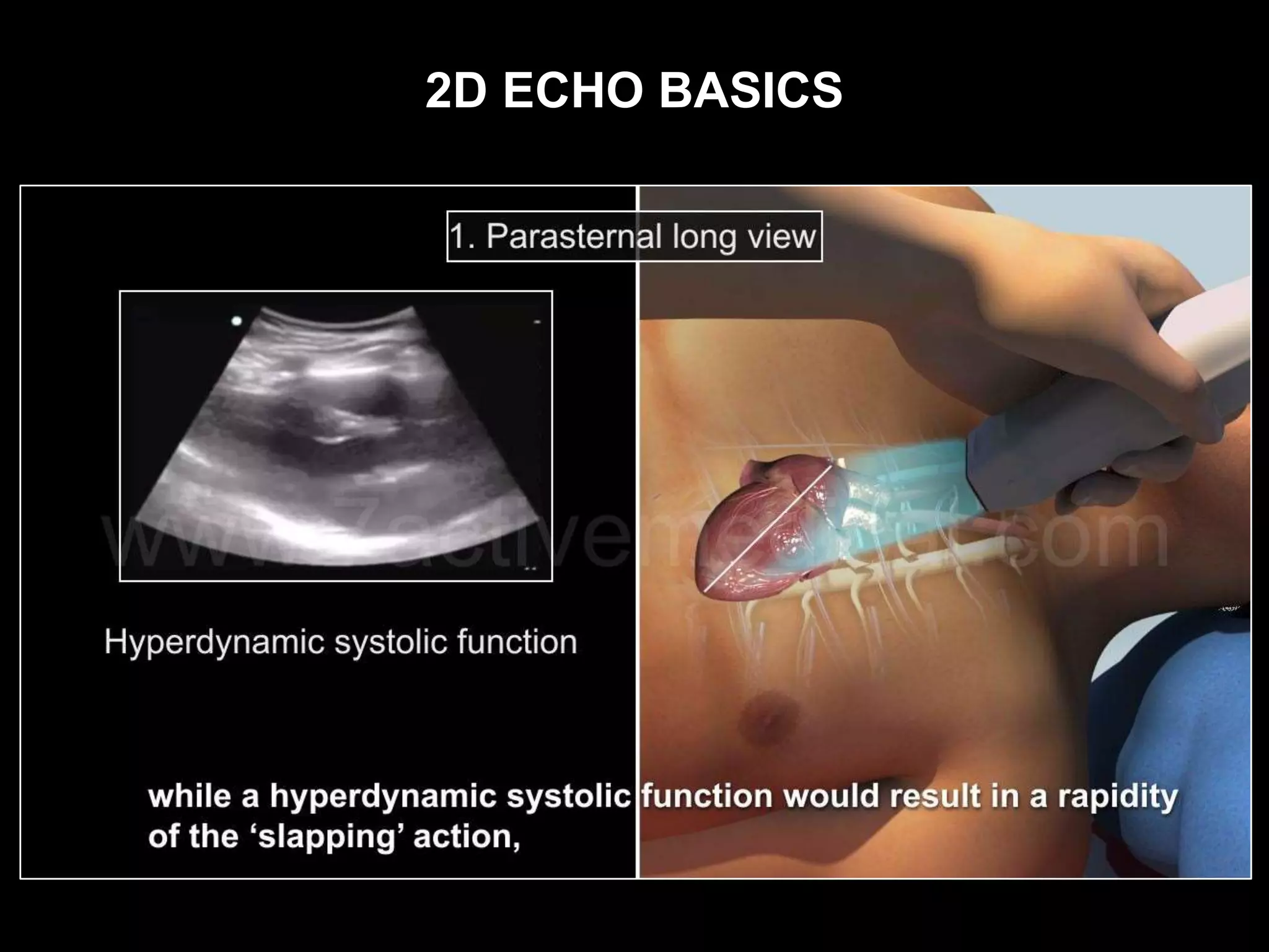 2D ECHO BASICS
 