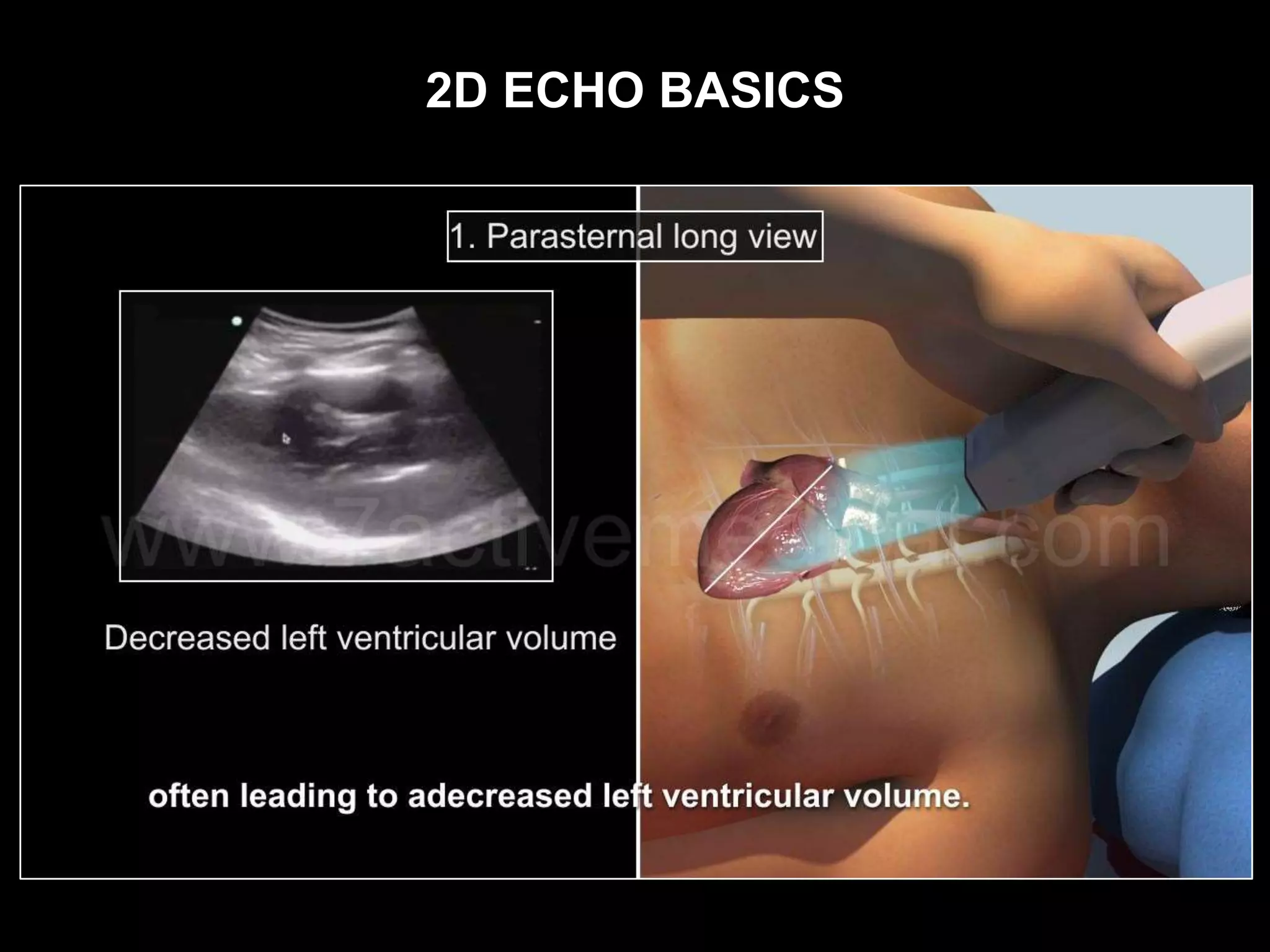 2D ECHO BASICS
 