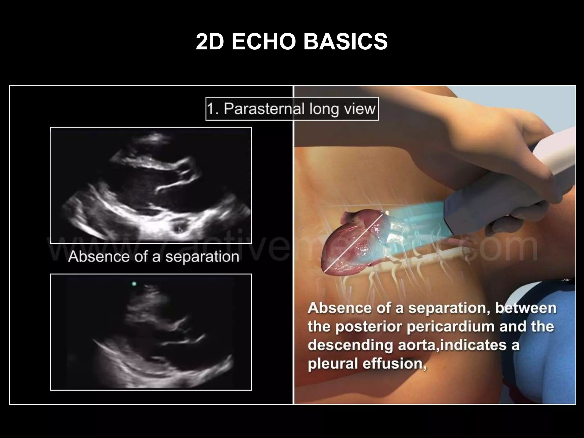 2D ECHO BASICS
 