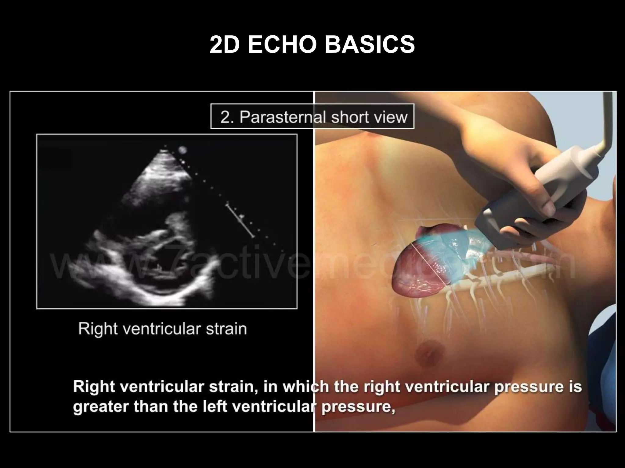 2D ECHO BASICS
 