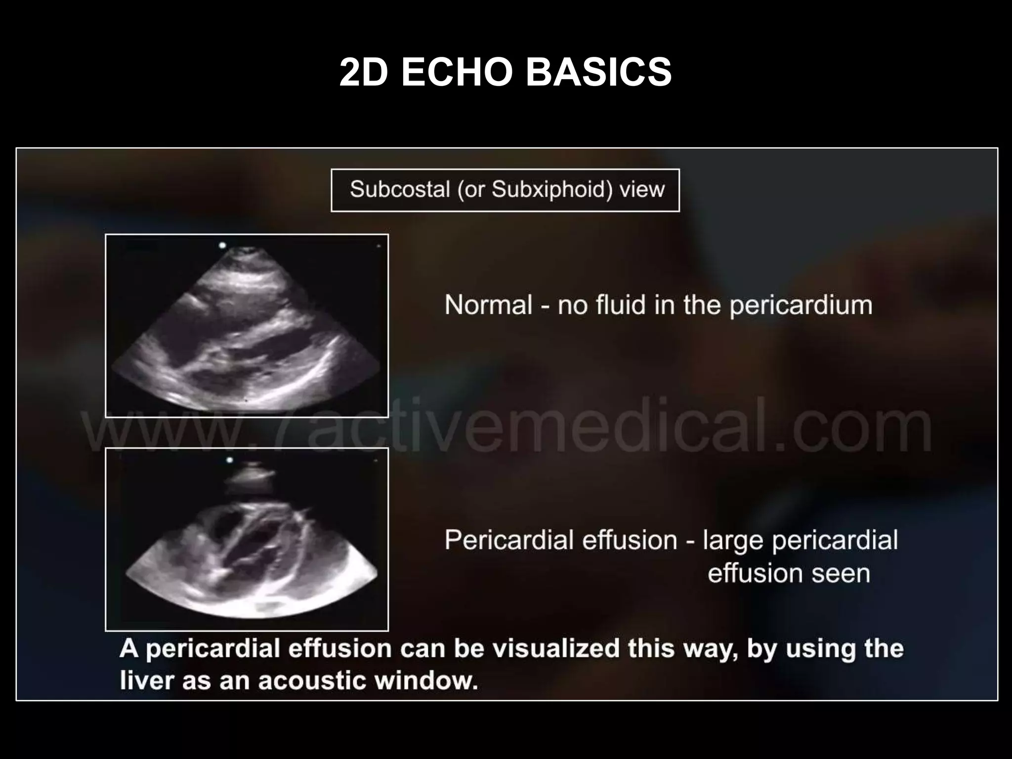 2D ECHO BASICS
 