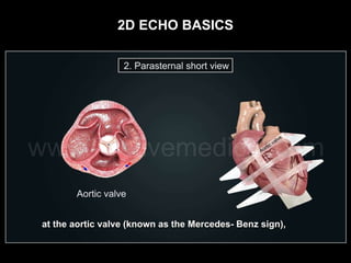2d Echo Basics | PPTX