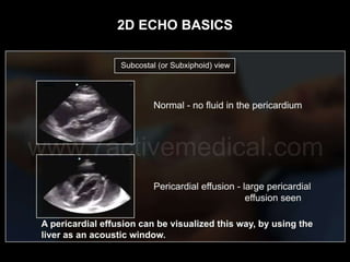 2d Echo Basics | PPTX
