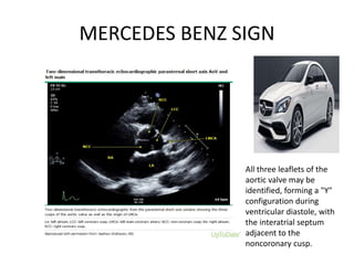 MERCEDES BENZ SIGN
All three leaflets of the
aortic valve may be
identified, forming a "Y"
configuration during
ventricular diastole, with
the interatrial septum
adjacent to the
noncoronary cusp.
 