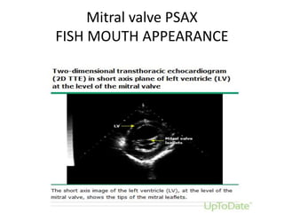 Mitral valve PSAX
FISH MOUTH APPEARANCE
 