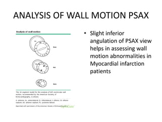 ANALYSIS OF WALL MOTION PSAX
• Slight inferior
angulation of PSAX view
helps in assessing wall
motion abnormalities in
Myocardial infarction
patients
 