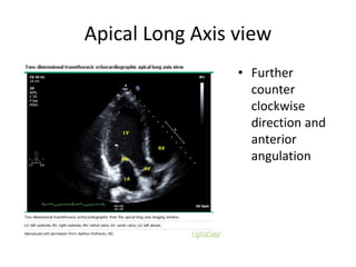 Apical Long Axis view
• Further
counter
clockwise
direction and
anterior
angulation
 